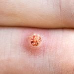 Vaksin HPV Setelah Menikah, Apakah Efektif?