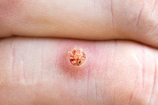 Enam Pertanyaan Seputar Virus HPV yang Wajib Anda Ketahui